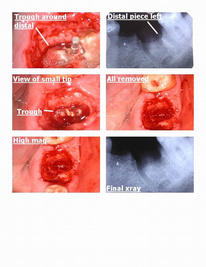 Molar extraction 2.jpg